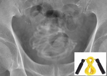 Idoso enrola, introduz corda de 2,3 metros e vai parar na mesa de cirurgia