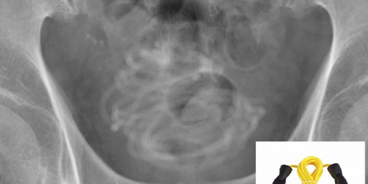 Idoso enrola, introduz corda de 2,3 metros e vai parar na mesa de cirurgia
