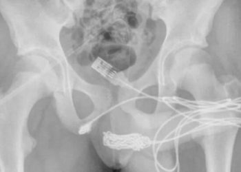 Garoto de 14 anos passa por cirurgia de emergência ao enfiar cabo USB no ‘piru’