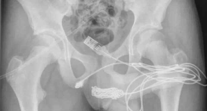 Garoto de 14 anos passa por cirurgia de emergência ao enfiar cabo USB no ‘piru’