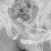 Garoto de 14 anos passa por cirurgia de emergência ao enfiar cabo USB no ‘piru’