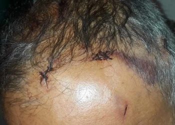 Homem é esfaqueado quatro vezes ao negar esmola: ‘maior trauma da vida’