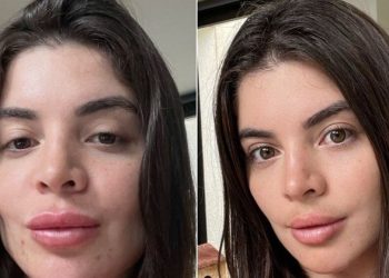 Gkay mostra antes e depois de retirar preenchimento labial, ‘tirei minha boca’, diz ela