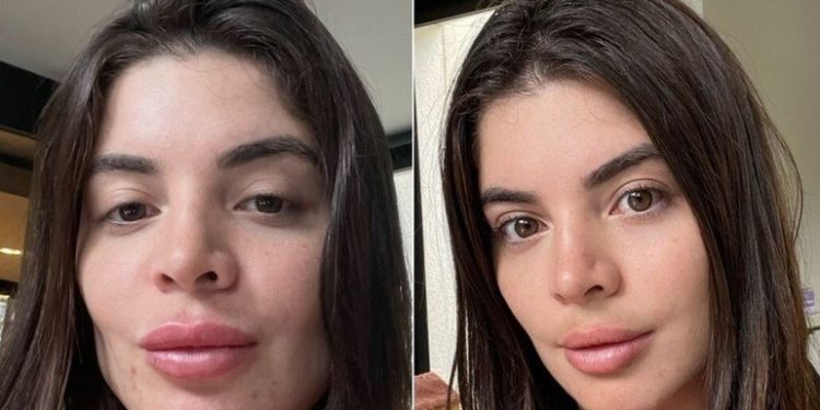 Gkay mostra antes e depois de retirar preenchimento labial, ‘tirei minha boca’, diz ela