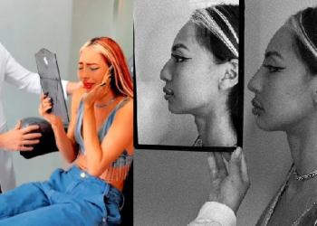 ‘Mais bonita que um tambaqui assado’, diz Ruivinha de Marte após plástica na boca, nariz e queixo