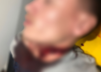 Jovem sobrevive a tentativa de homicídio com buraco na garganta; CENAS FORTES