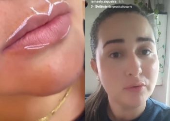 ‘Parece que sou outra pessoa’, diz esposa traída da Bemol após fazer preenchimento labial