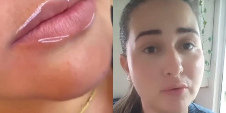 ‘Parece que sou outra pessoa’, diz esposa traída da Bemol após fazer preenchimento labial