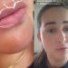 ‘Parece que sou outra pessoa’, diz esposa traída da Bemol após fazer preenchimento labial