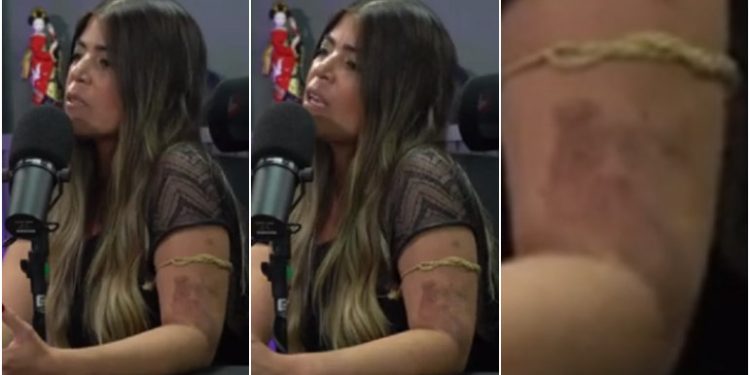 Bruna Surfistinha aparece com hematomas e diz que foi ex-marido