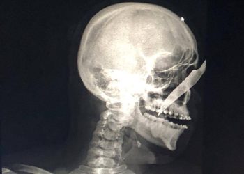 Jovem fica com faca cravada no nariz após ser atacado por bêbado no interior do AM