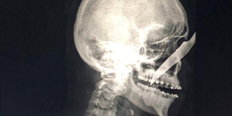 Jovem fica com faca cravada no nariz após ser atacado por bêbado no interior do AM