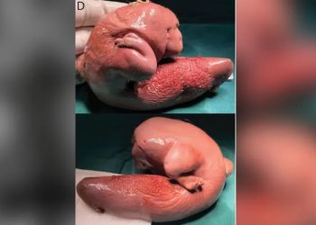 Médicos encontram feto gêmeo dentro de cérebro de menina de 1 ano