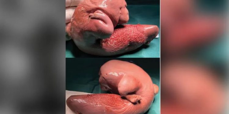 Médicos encontram feto gêmeo dentro de cérebro de menina de 1 ano