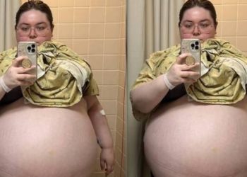 Mulher remove tumor de 47 kg do ovário: ‘grávida de 10 filhos’