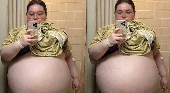 Mulher remove tumor de 47 kg do ovário: ‘grávida de 10 filhos’