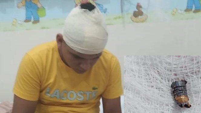 Vítima de bala perdida no Amazonas fica com projétil preso no couro cabeludo