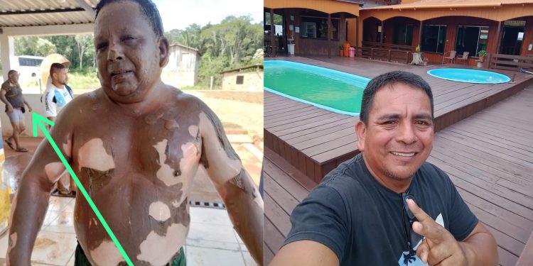 Vítima de explosão de embarcação morre no 28 de Agosto