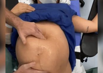 Médico viraliza ao ‘encaixar bebê sentado’ minutos antes do parto