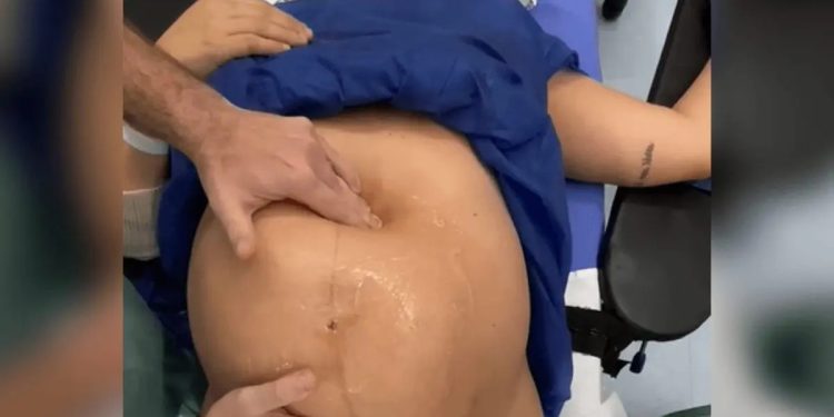 Médico viraliza ao ‘encaixar bebê sentado’ minutos antes do parto