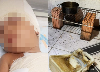 Mãe e filho ficam com queimaduras de 3º grau após ela improvisar fogão e usar gasolina