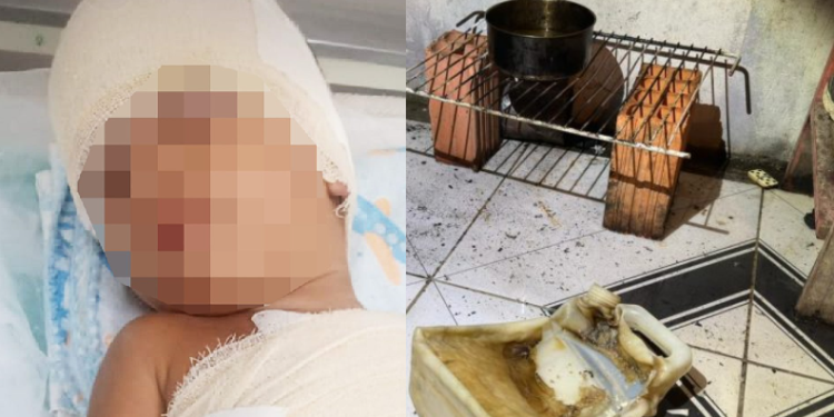 Mãe e filho ficam com queimaduras de 3º grau após ela improvisar fogão e usar gasolina
