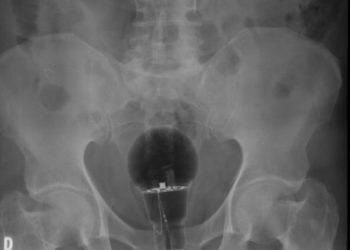 Homem vai ao hospital com lâmpada presa no fio terra: ‘ideias brilhantes’