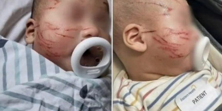 Criança vai para creche e volta com o rosto todo arranhado