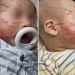 Criança vai para creche e volta com o rosto todo arranhado
