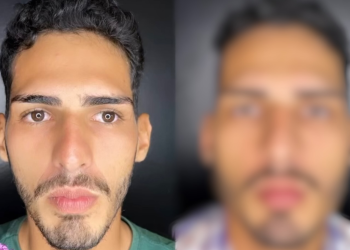 ‘Tá a mesma coisa’, dizem seguidores após Agenor Tupinambá revelar resultado final de harmonização facial; vídeo