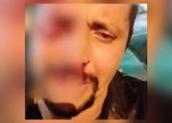 Homem é confundido com ladrão, perde o olho e fica desesperado: ‘Por causa de um otário’; veja