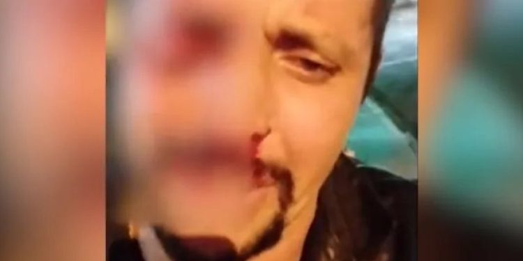 Homem é confundido com ladrão, perde o olho e fica desesperado: ‘Por causa de um otário’; veja