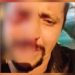 Homem é confundido com ladrão, perde o olho e fica desesperado: ‘Por causa de um otário’; veja