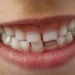 Cientistas desenvolvem medicamento que faz os dentes crescerem novamente