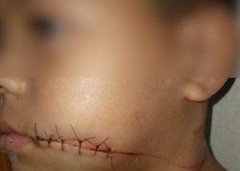 Menino de 7 anos tem boca cortada por linha com cerol