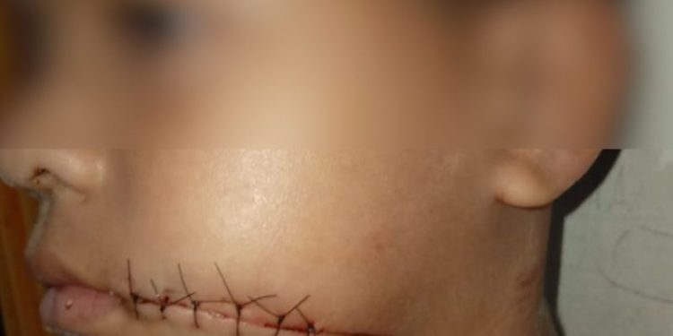 Menino de 7 anos tem boca cortada por linha com cerol