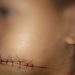 Menino de 7 anos tem boca cortada por linha com cerol