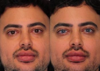 Homem faz procedimento estético para ficar com os olhos azuis