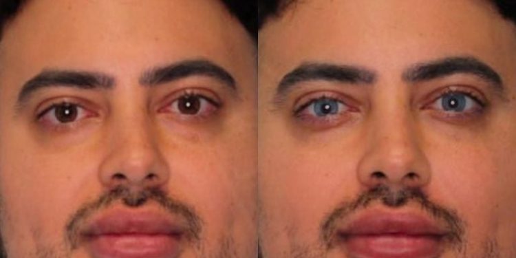 Homem faz procedimento estético para ficar com os olhos azuis