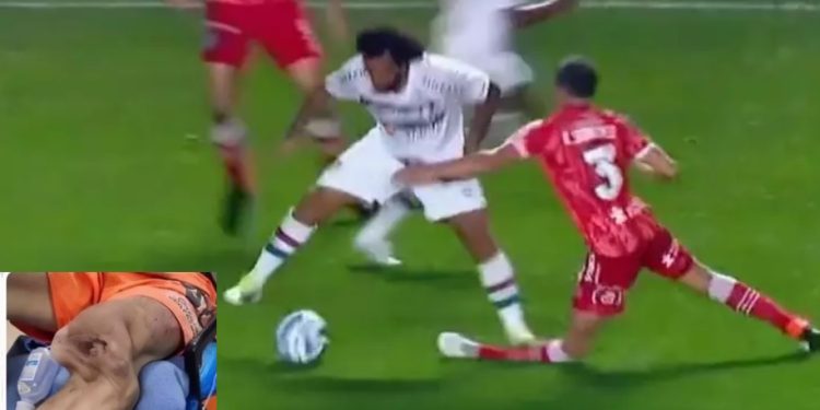 Zagueiro que teve perna quebrada por Marcelo perdoa o jogador: ‘admiro como pessoa’