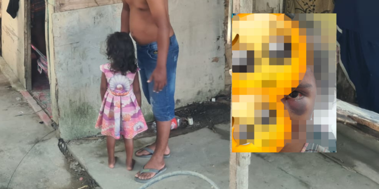 Criança de 3 anos leva bicuda no olho durante briga de família
