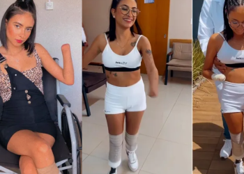 Meses após ter pernas e mãos amputadas, jovem comemora poder andar com próteses