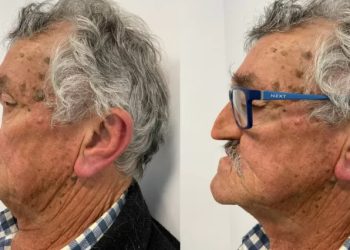 Vídeo: homem passa dois anos vivendo sem o nariz devido a um câncer: ‘tive medo’