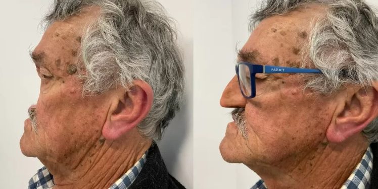 Vídeo: homem passa dois anos vivendo sem o nariz devido a um câncer: ‘tive medo’