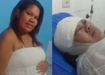 Mulher acorda com o rosto desfigurado no hospital e diz que foi vítima do marido: ‘ciúme da sogra’