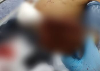 Traficantes arrancam dedo de suposto criminoso e avisam: ‘na próxima vamos te matar’