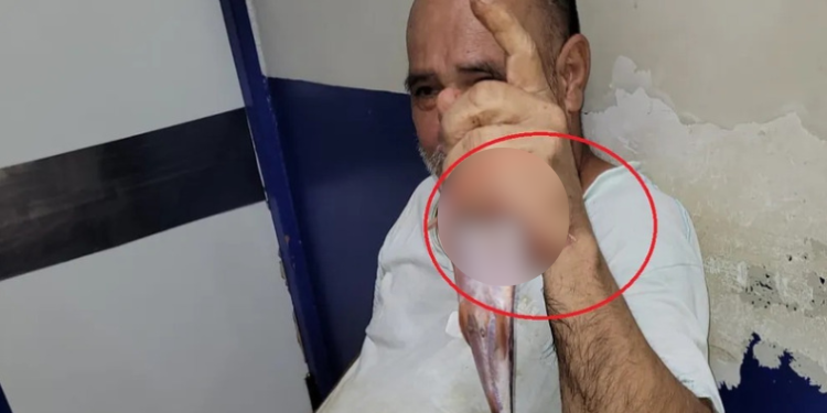 Pescador tem mão atravessada por ferrão de peixe durante pescaria