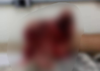 Guarda municipal tem mão detonada ao acionar bomba achando que era rastreador