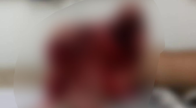 Guarda municipal tem mão detonada ao acionar bomba achando que era rastreador