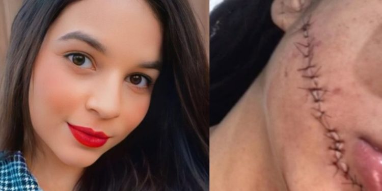 Vídeo: um ano depois, mulher que cortou rosto de passageira enquanto ela dormia é presa